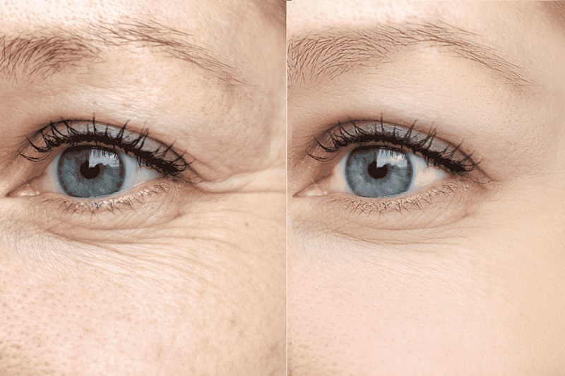 Blepharoplasty