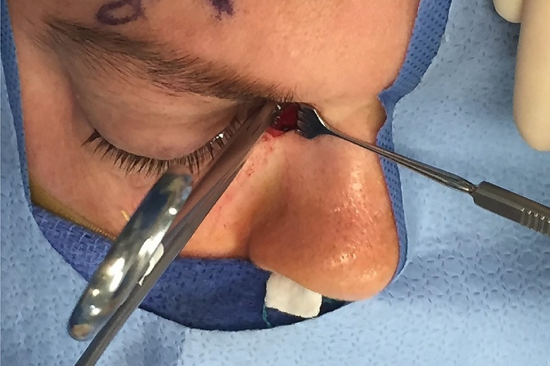 Dacryocystorhinostomy